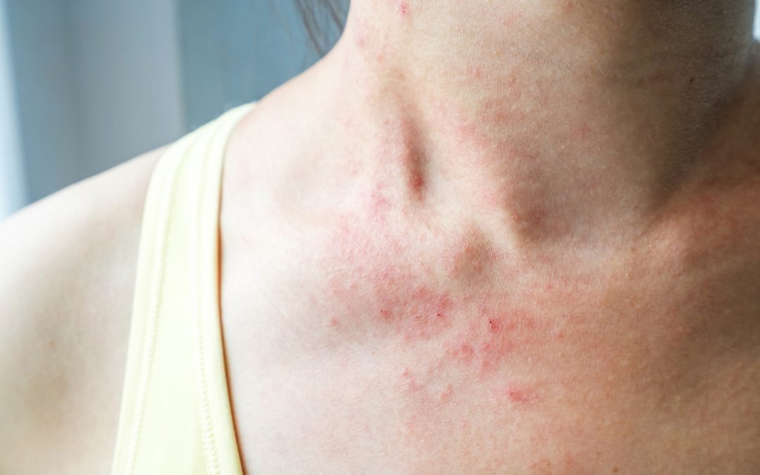Gebarste eczeemhuid bevorderlijk voor allergieën