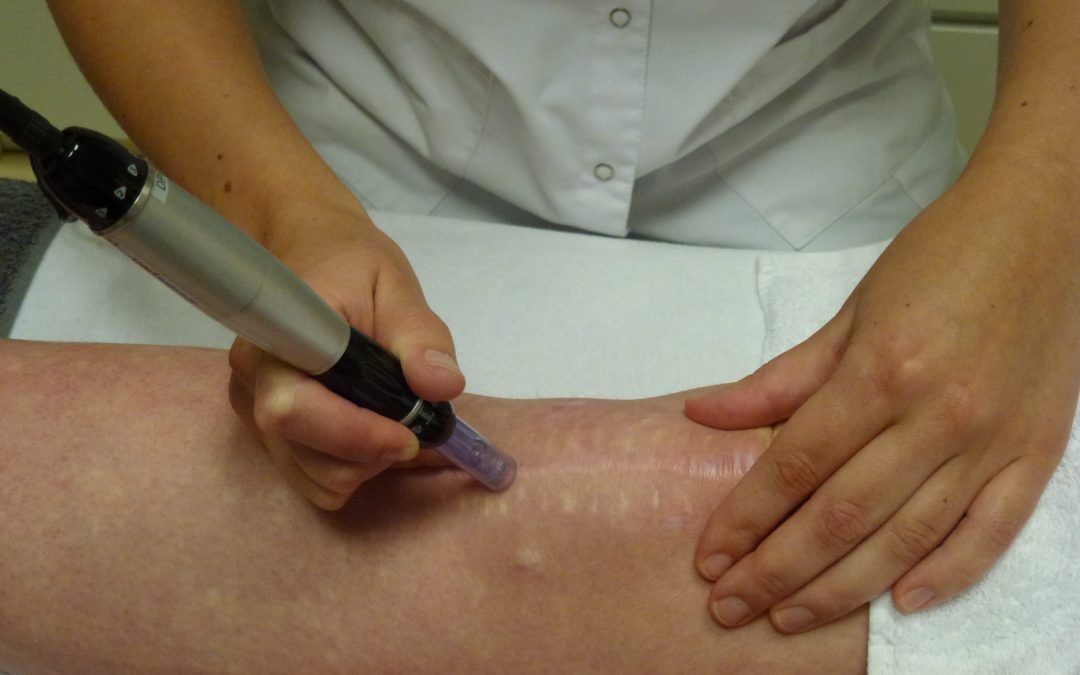 Hoe werkt huidverbetering met Dermapen?